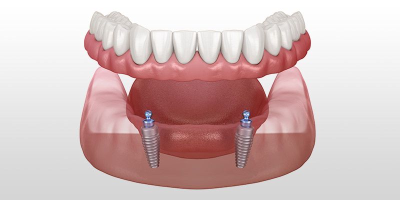 All-On-2 removable denture