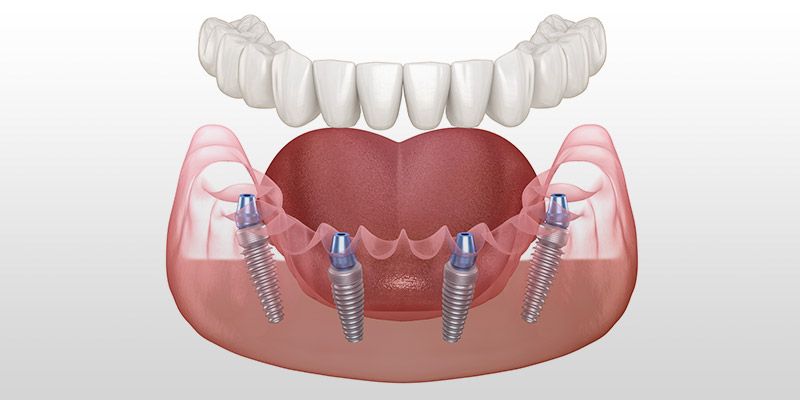 All-On-4 Teeth Permanently Fixed