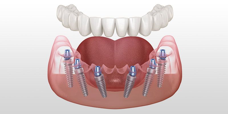 All-On-6 Teeth Permanently Fixed