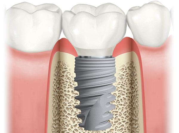 Titanium implants are typically produced in a two-piece system, consisting of two main components.