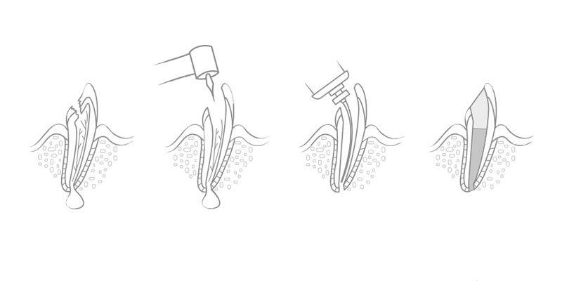 Stages of Endodontic Treatment