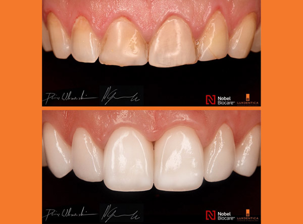 In this transformation, crowns and veneers were crafted to enhance aesthetics.