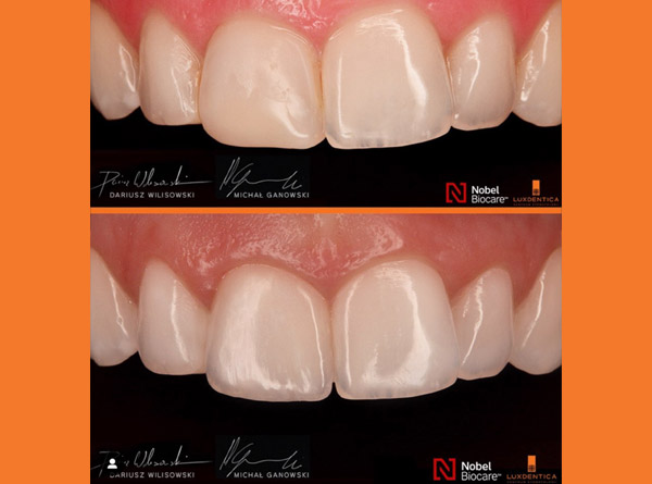 Subtle correction of both upper central incisors.