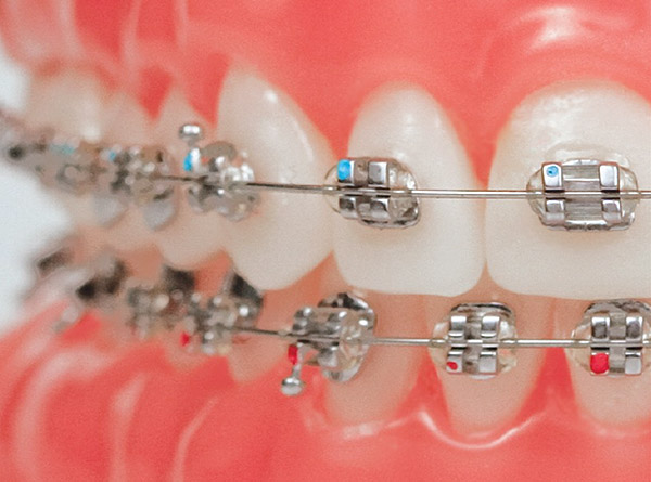 Traditional orthodontic braces: